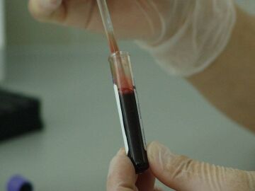 Demuestran la eficacia de una nueva inmunoterapia frente al mieloma multiple resistente