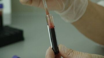 Demuestran la eficacia de una nueva inmunoterapia frente al mieloma multiple resistente