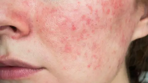Rosacea Rosacea
