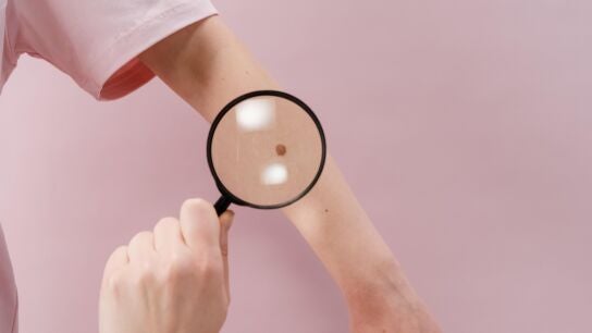 Melanoma