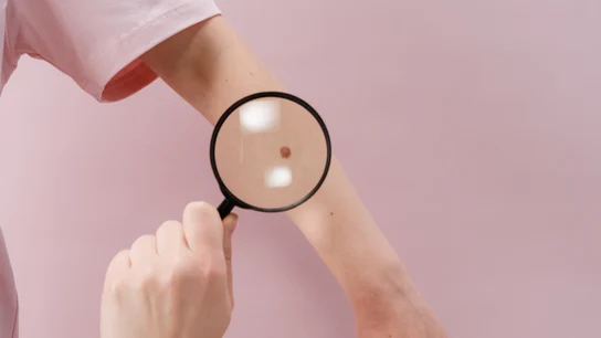 Melanoma Melanoma