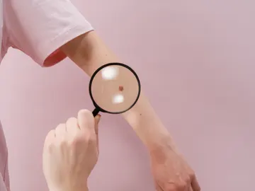 Melanoma Melanoma