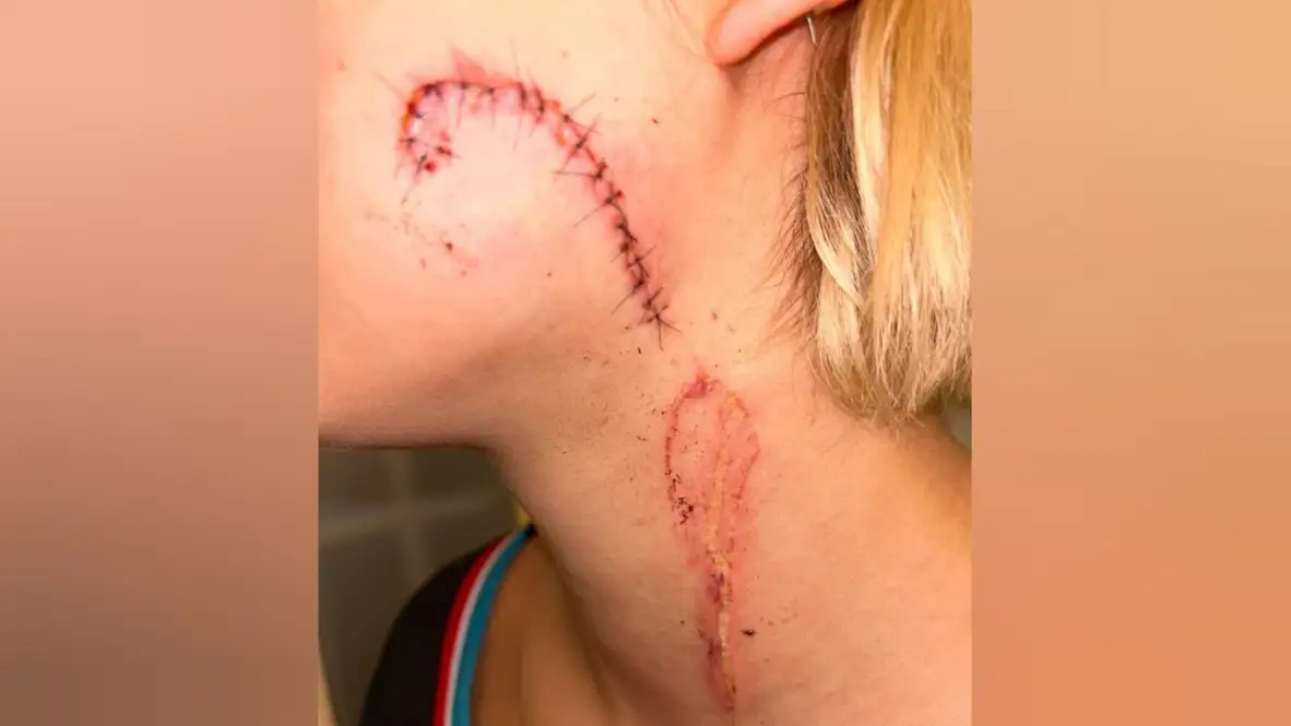 Así ha quedado el cuello de la joven acuchillada en Francia Así ha quedado el cuello de la joven acuchillada en Francia
