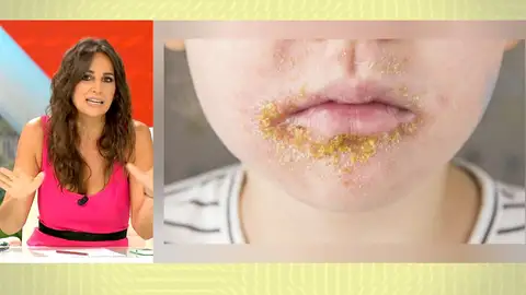 Brote de impétigo. Brote de impétigo.