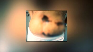 La vida de Yurena, en riesgo tras someterse a una abdominoplastia en Turquía: 