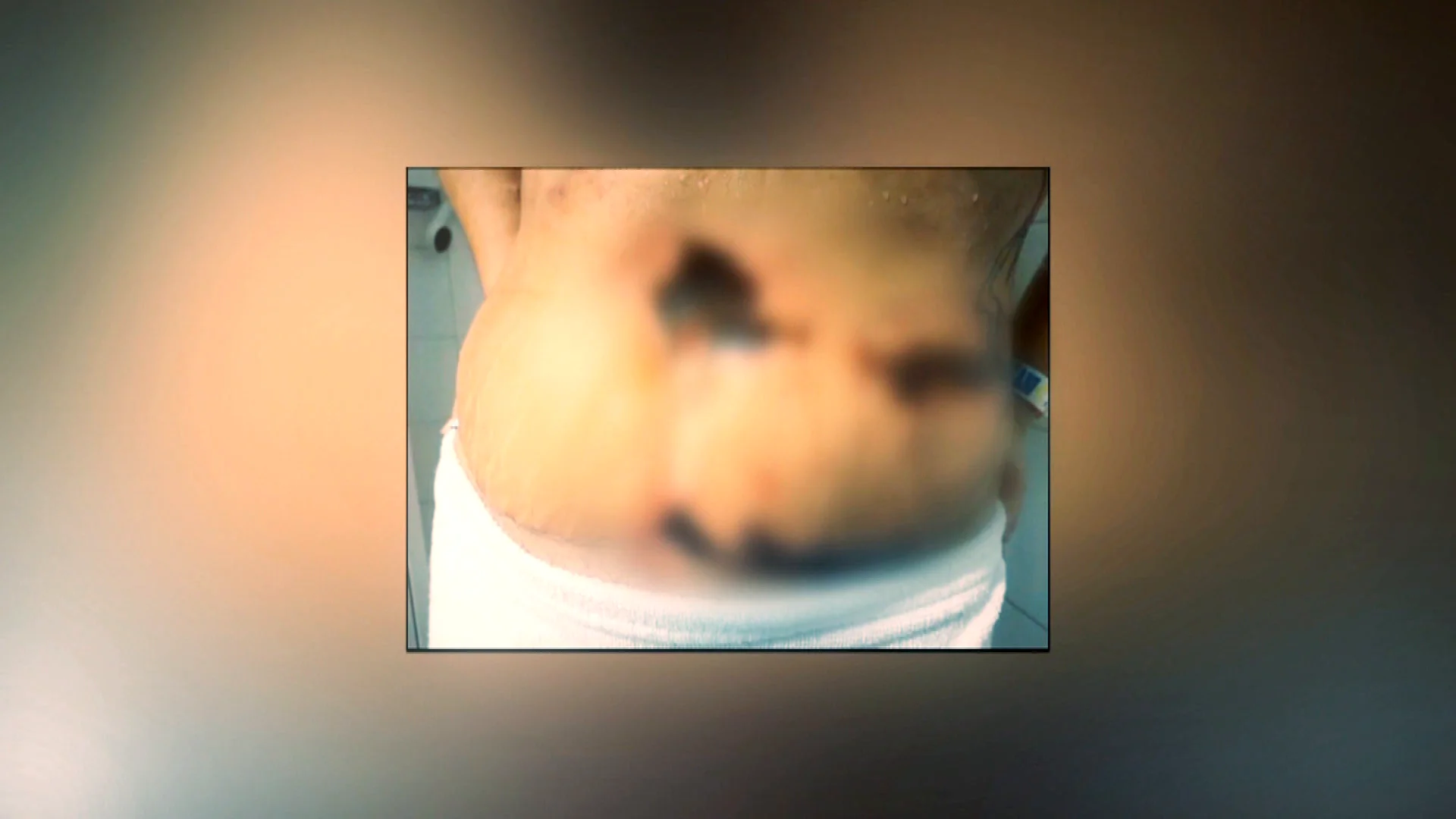La vida de Yurena, en riesgo tras someterse a una abdominoplastia en Turquía La vida de Yurena, en riesgo tras someterse a una abdominoplastia en Turquía