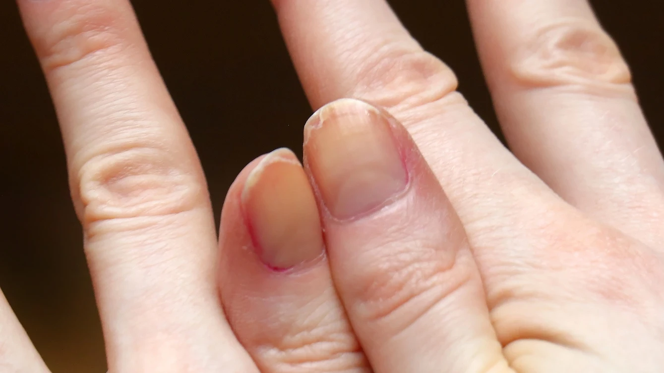 Uñas amarillentas Uñas amarillentas