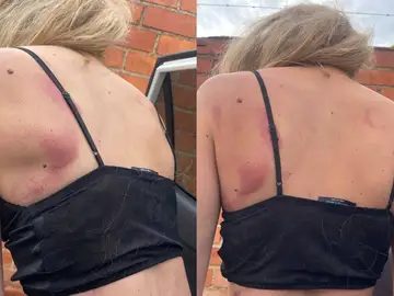 Joven agredida en una discoteca de Castellón tras defender a una amiga Joven agredida en una discoteca de Castellón tras defender a una amiga