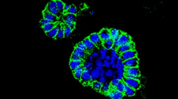 organoides de cáncer de colon