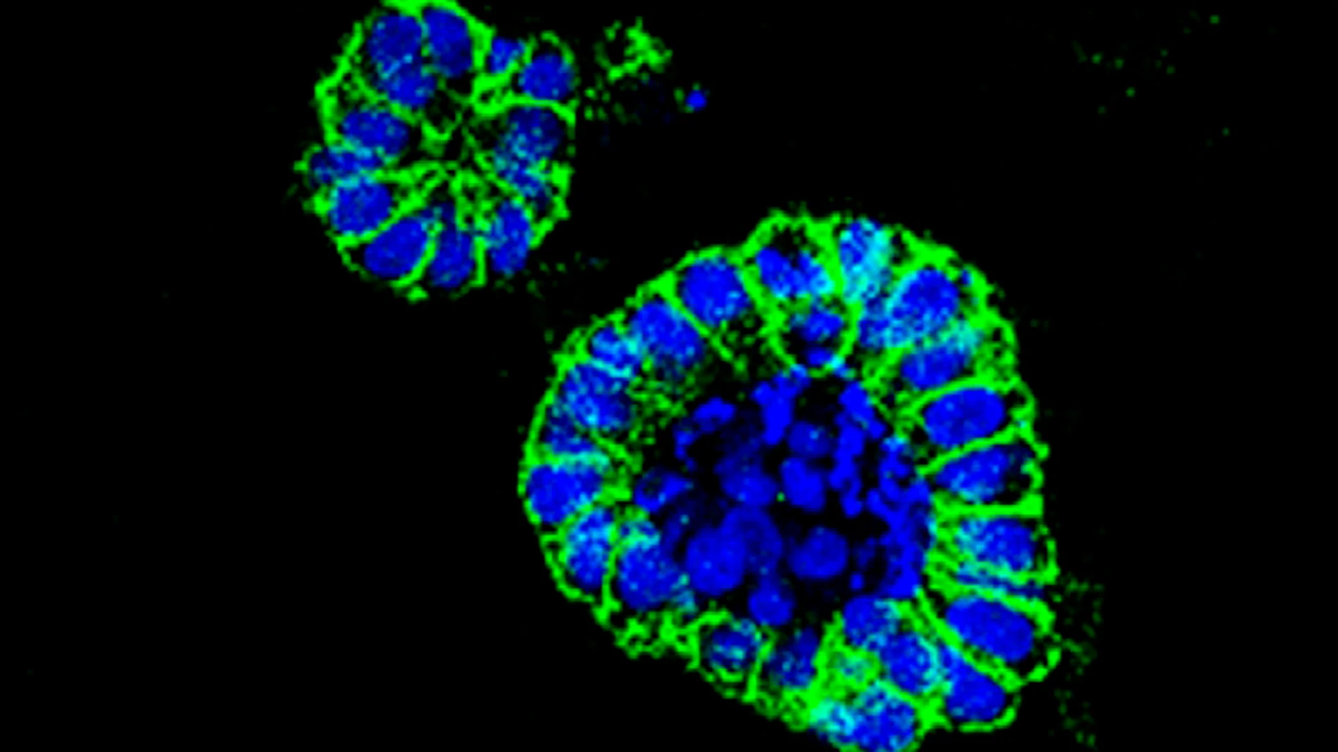 organoides de cáncer de colon organoides de cáncer de colon