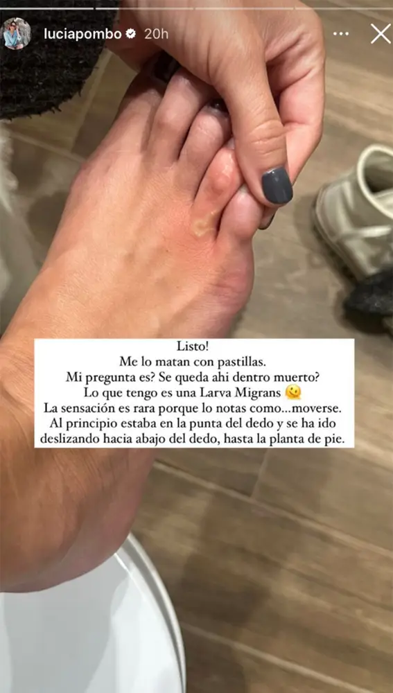 Lucía Pombo enseña el gusano de su pie