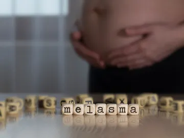 Melasma en el embarazo Melasma en el embarazo