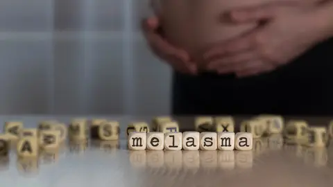 Melasma en el embarazo Melasma en el embarazo