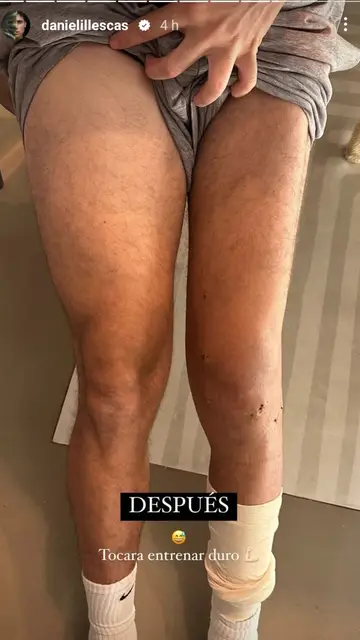 Daniel Illescas enseña el cambio de sus piernas tras su operación Daniel Illescas enseña el cambio de sus piernas tras su operación