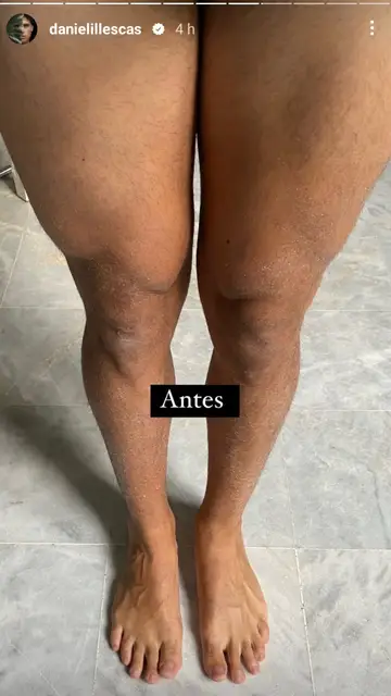 Daniel Illescas enseña sus piernas tras su operación Daniel Illescas enseña sus piernas tras su operación