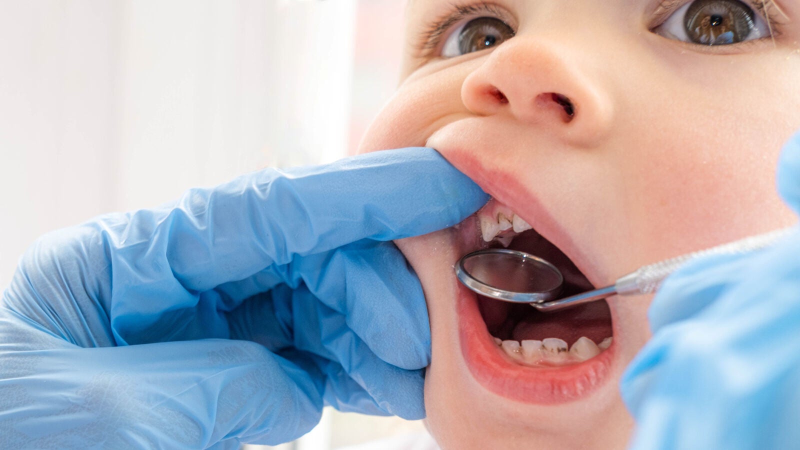 ¿Se deben tratar las caries en los dientes de leche?