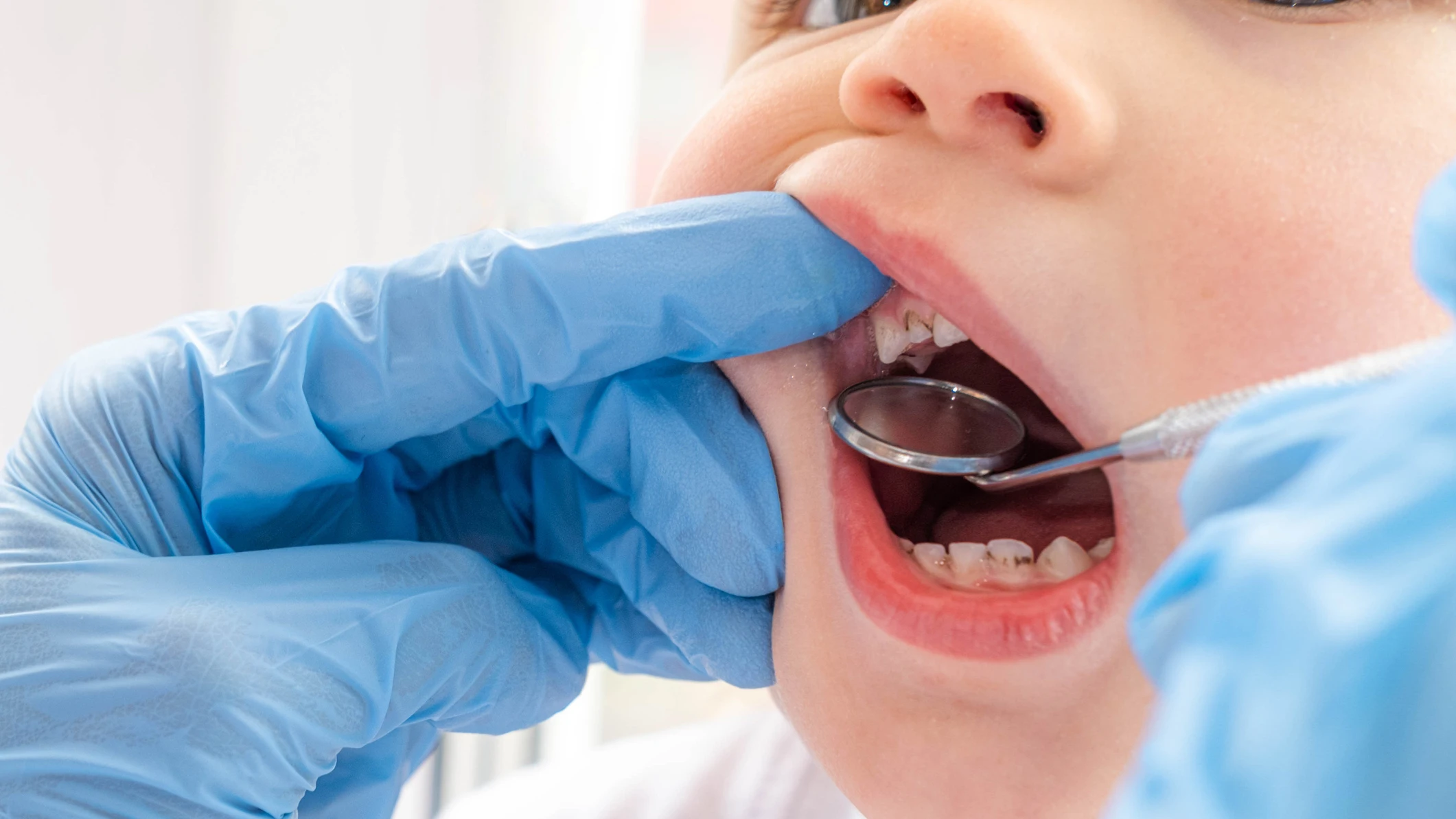 Niño con caries Niño con caries