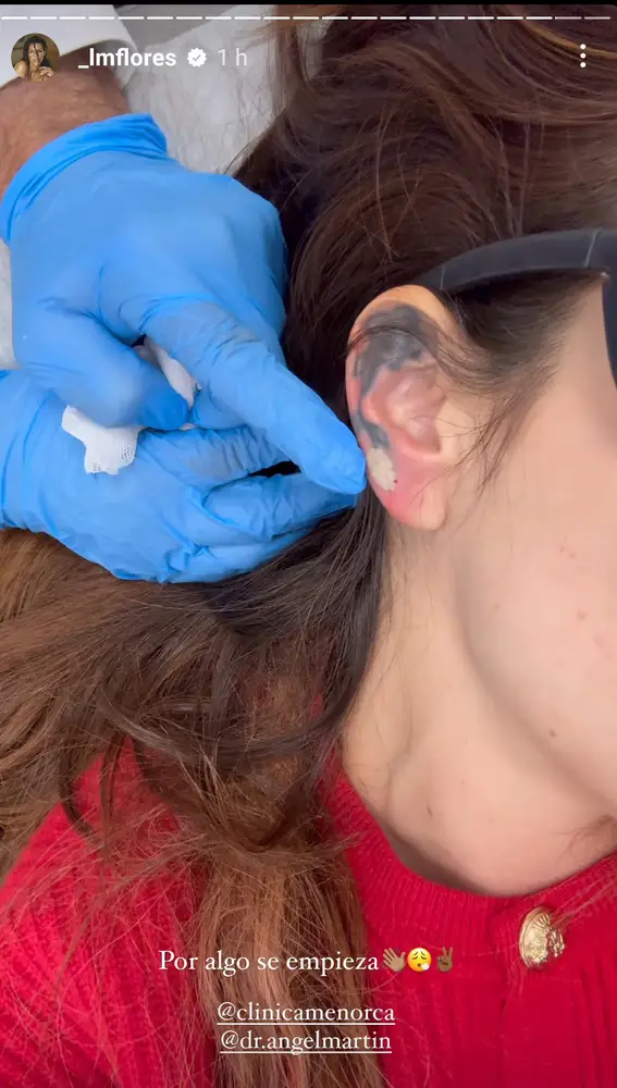Laura Matamoros se borra el tatuaje de la oreja
