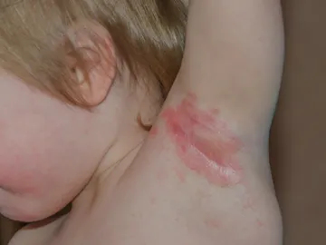 Dermatitis atópica en la axila de un niño Dermatitis atópica en la axila de un niño