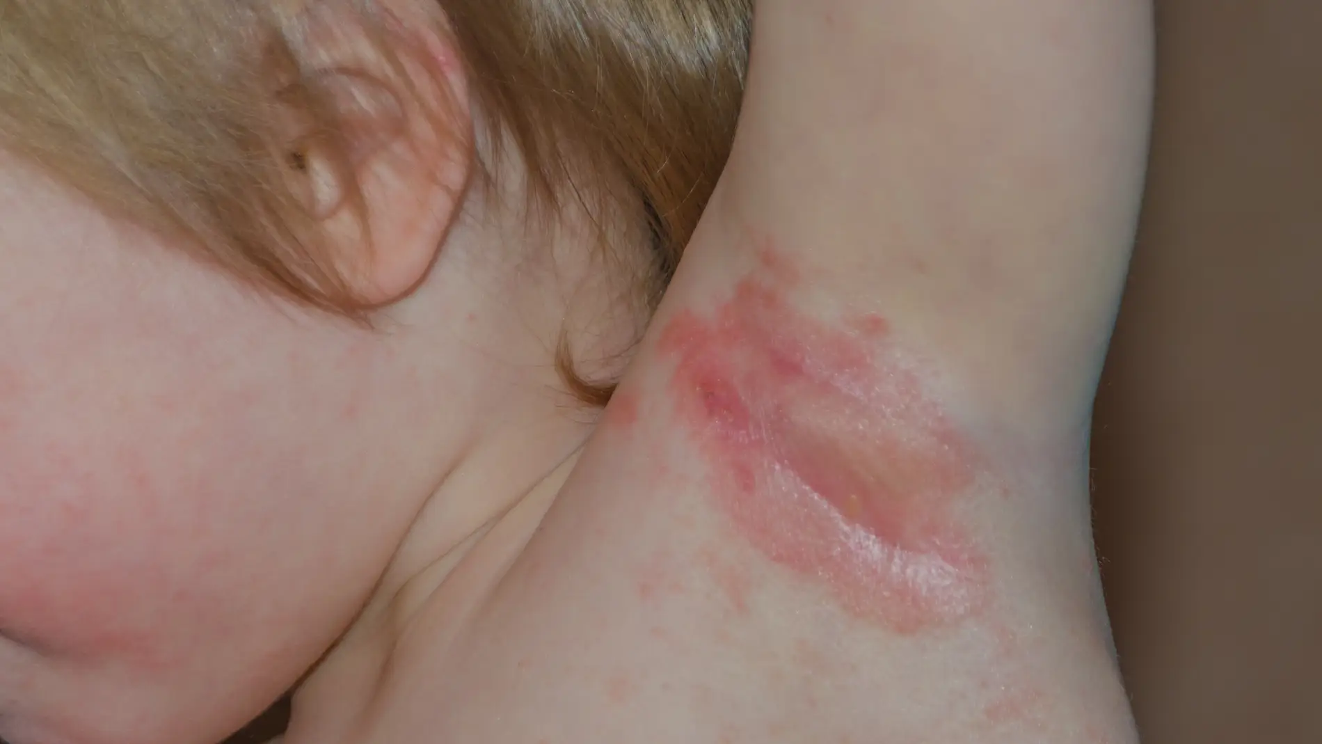 Dermatitis atópica en la axila de un niño