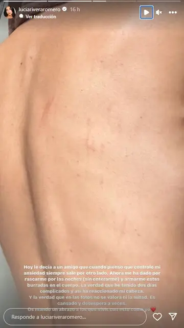 Lucía Rivera muestra las secuelas de la ansiedad Lucía Rivera muestra las secuelas de la ansiedad
