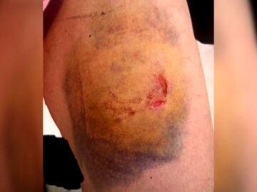 Una agente de la policía de Picassent, víctima del mordisco en la pierna de un detenido fuera de sí