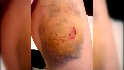 Una agente de la policía de Picassent, víctima del mordisco en la pierna de un detenido fuera de sí Una agente de la policía de Picassent, víctima del mordisco en la pierna de un detenido fuera de sí