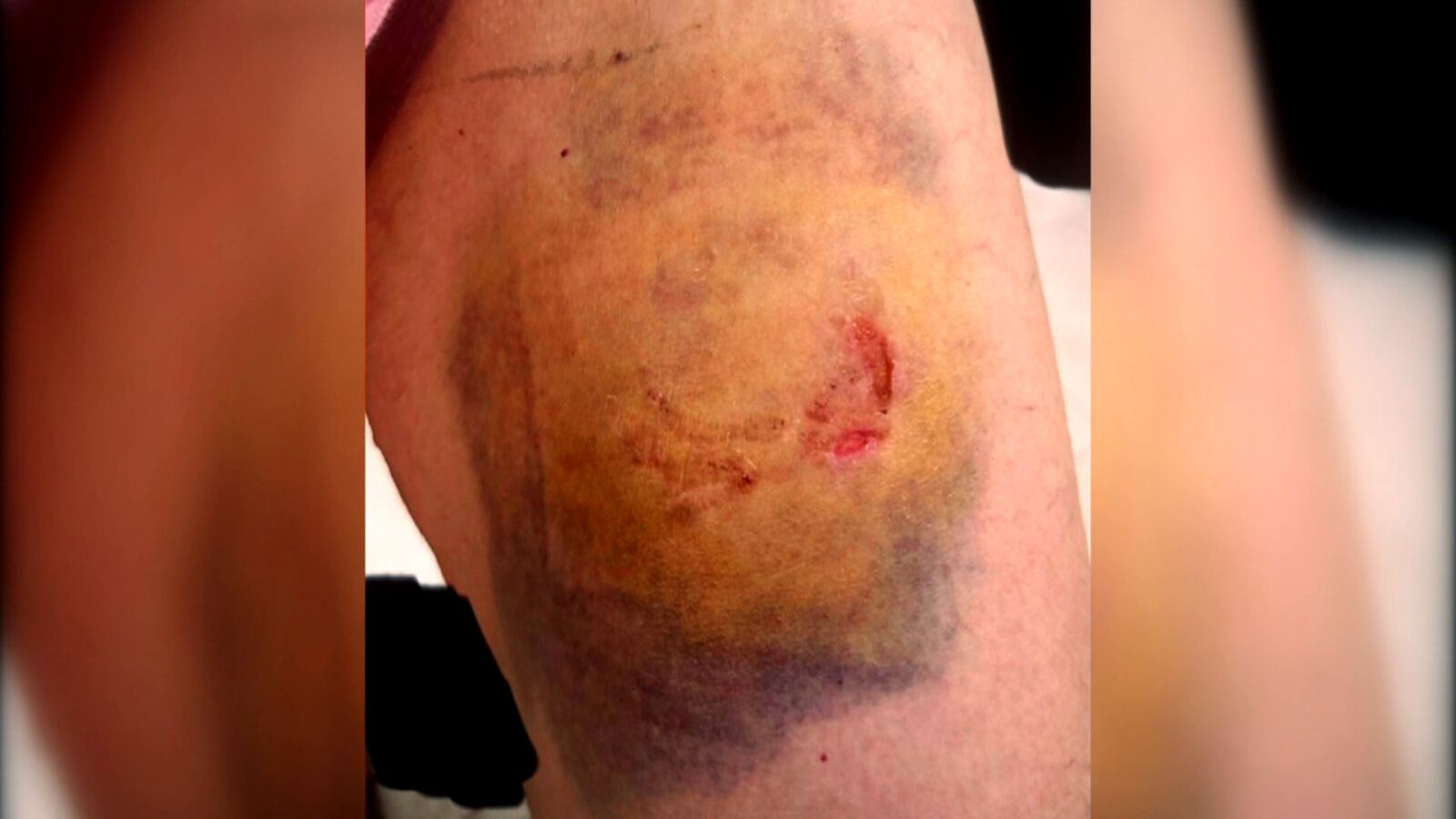 Una agente de la policía de Picassent, víctima del mordisco en la pierna de un detenido fuera de sí