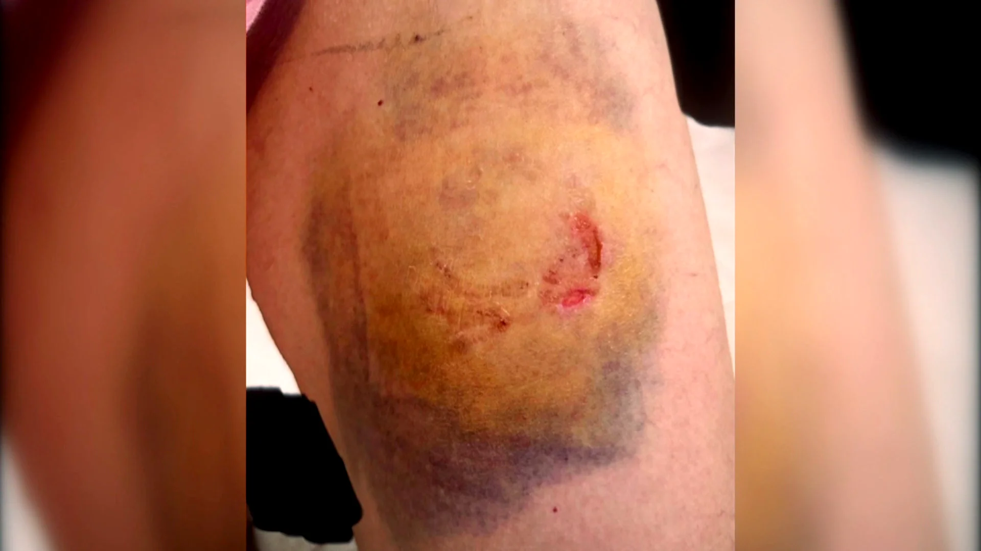 Una agente de la polic&iacute;a de Picassent, v&iacute;ctima del mordisco en la pierna de un detenido fuera de s&iacute;