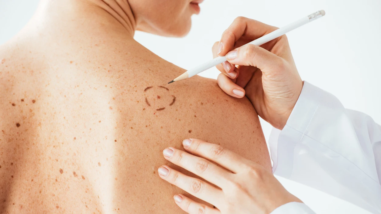 Piel con pecas revisada por una dermatóloga Piel con pecas revisada por una dermatóloga