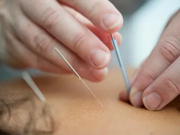 Acupuntura Acupuntura