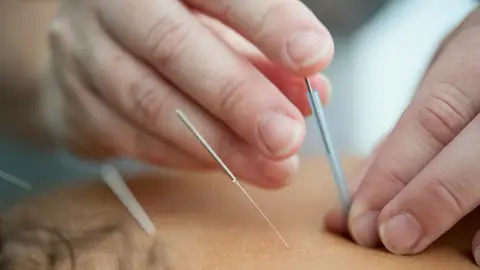 Acupuntura Acupuntura