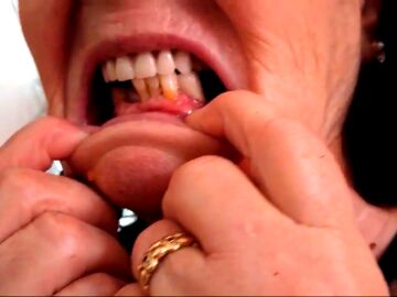 Amelia, sin dientes ni dinero por la mala praxis de su odontólogo: "No puedo comer ni un bocadillo ni nada"