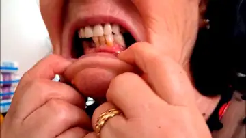 Amelia, sin dientes ni dinero por la mala praxis de su odontólogo: "No puedo comer ni un bocadillo ni nada"
