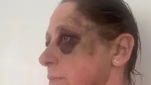 Melanie Cuthbertson capta cómo quedó su cara después de la brutal agresión 