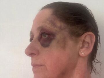 Melanie Cuthbertson capta cómo quedó su cara después de la brutal agresión 