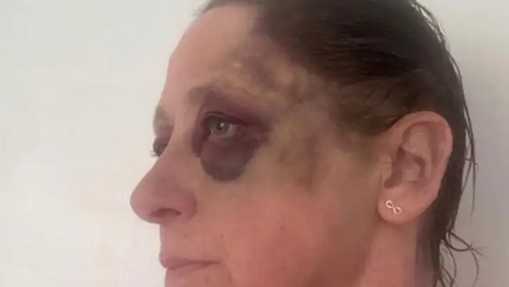 Melanie Cuthbertson capta cómo quedó su cara después de la brutal agresión Melanie Cuthbertson capta cómo quedó su cara después de la brutal agresión