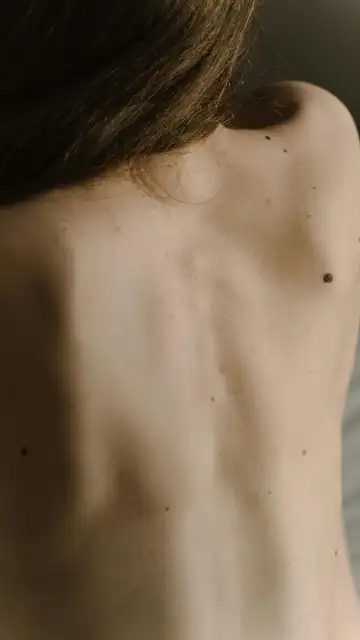 Mujer con lunares en la espalda Mujer con lunares en la espalda