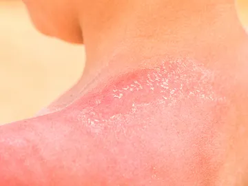 Quemadura solar Quemadura solar