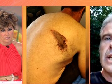 Primera víctima de la avispa asiática en España: "Se metió en la camiseta y me mordió hasta cinco veces"