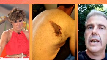 Primera víctima de la avispa asiática en España: "Se metió en la camiseta y me mordió hasta cinco veces"