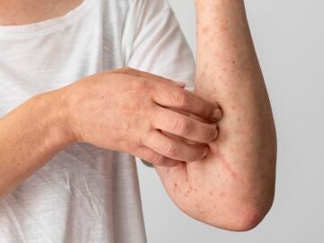 Ejemplo de dermatitis en un brazo