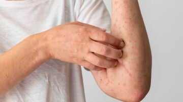 Ejemplo de dermatitis en un brazo