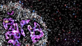 Met&aacute;stasis de c&aacute;ncer colorrectal (mitad izquierda de la imagen) en el h&iacute;gado. C&eacute;lulas de c&aacute;ncer colorrectal, en color magenta, rodeadas de otras c&eacute;lulas, en blanco, dentro de la met&aacute;stasis (imagen de microscopio).