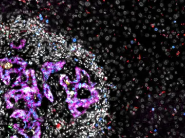Metástasis de cáncer colorrectal (mitad izquierda de la imagen) en el hígado. Células de cáncer colorrectal, en color magenta, rodeadas de otras células, en blanco, dentro de la metástasis (imagen de microscopio). Metástasis de cáncer colorrectal (mitad izquierda de la imagen) en el hígado. Células de cáncer colorrectal, en color magenta, rodeadas de otras células, en blanco, dentro de la metástasis (imagen de microscopio).