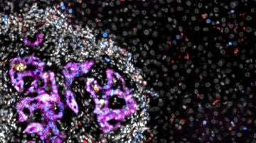 Metástasis de cáncer colorrectal (mitad izquierda de la imagen) en el hígado. Células de cáncer colorrectal, en color magenta, rodeadas de otras células, en blanco, dentro de la metástasis (imagen de microscopio).