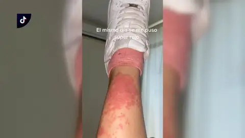 Picaduras de medusa, cortes o quemaduras: los peligros a los que nos exponemos en un día de playa Picaduras de medusa, cortes o quemaduras: los peligros a los que nos exponemos en un día de playa