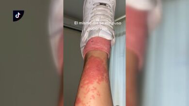 Picaduras de medusa, cortes o quemaduras: los peligros a los que nos exponemos en un día de playa