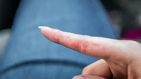 Dishidrosis Dishidrosis