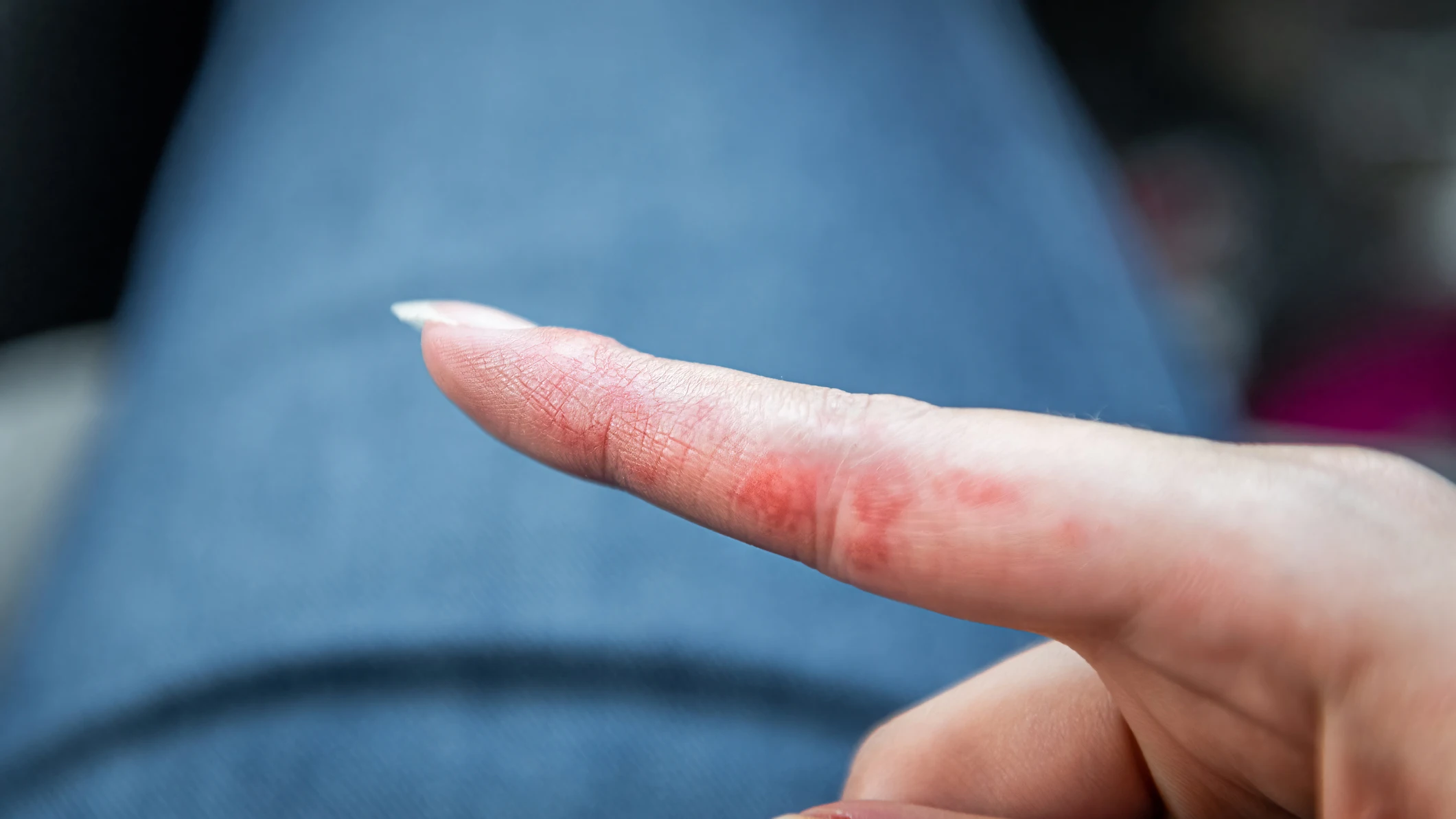 Dishidrosis Dishidrosis